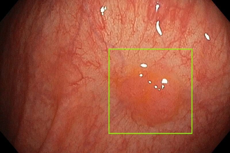 Sessil serratierende Läsion