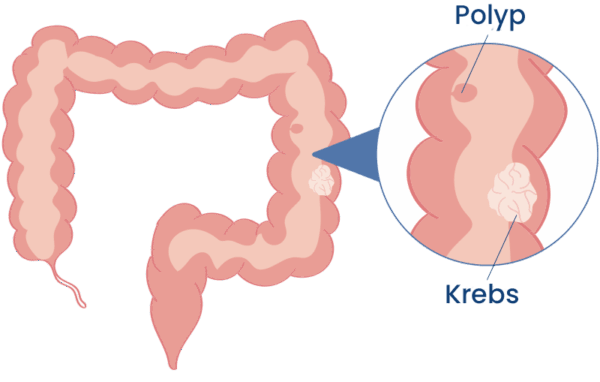 Schaubild: Unterschied zwischen einem Polyp und einem krebsartigen Geschwür im Darm
