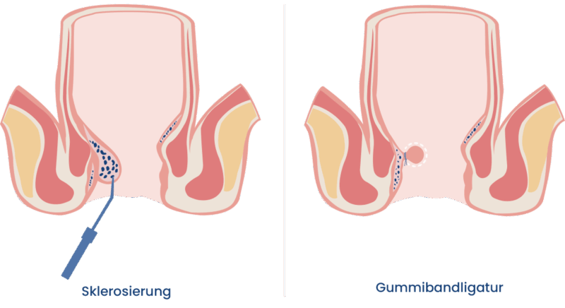 Schaubild: Hämorrhoiden-Sklerosierung und Gummibandligatur