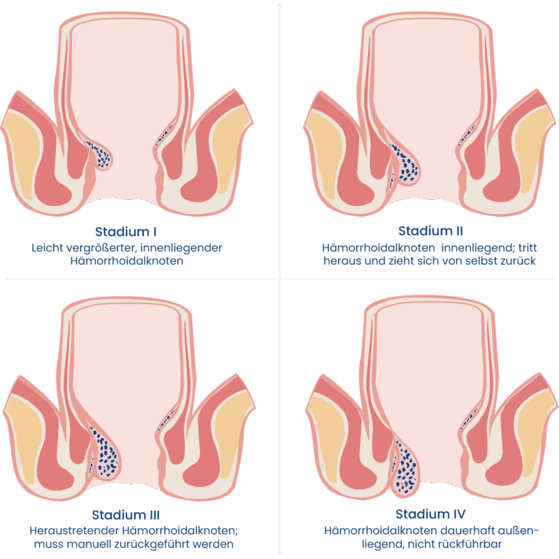 Schaubild: Stadien der Hämorrhoiden-Leiden